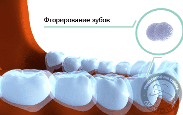 Вартість реминерализации зубів: виготовлення капи + вартість фторсодержащего гелю = 2010 грн за одну щелепу або 3420 грн за дві щелепи